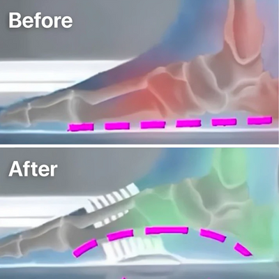 StepRelief™ | Orthopädische Fußgewölbestütze [1+1 Gratis]