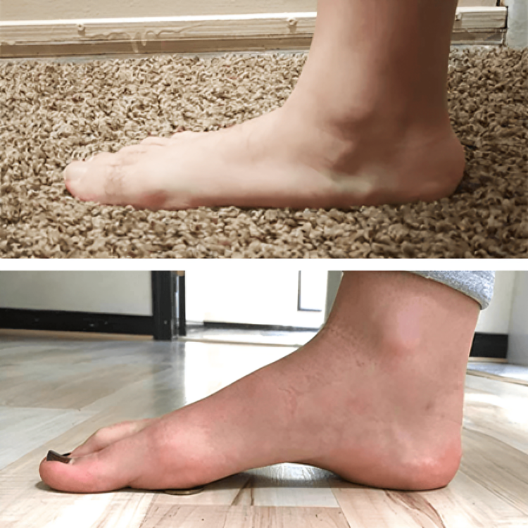 StepRelief™ | Orthopädische Fußgewölbestütze [1+1 Gratis]