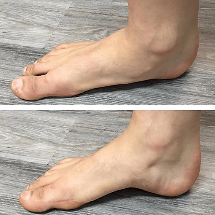 StepRelief™ | Orthopädische Fußgewölbestütze [1+1 Gratis]