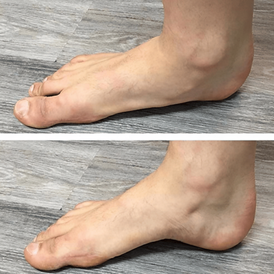 StepRelief™ | Orthopädische Fußgewölbestütze [1+1 Gratis]